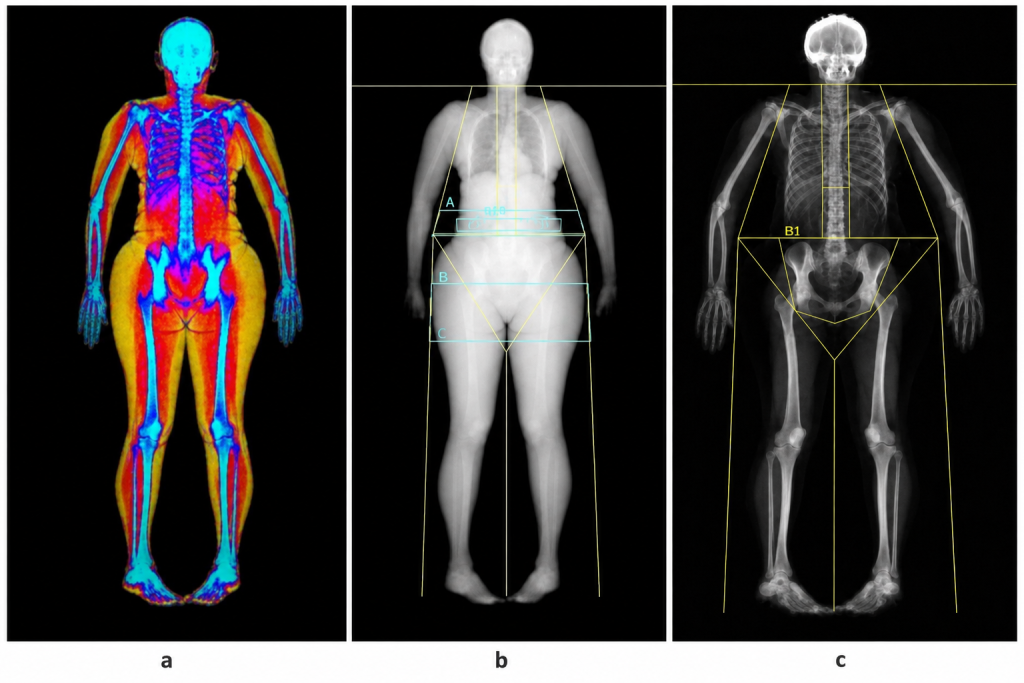 Estudo aponta relação entre gordura abdominal e maior risco de perda urinária em mulheres estudo-aponta-relacao-entre-gordura-abdominal-e-maior-risco-de-perda-urinaria-em-mulheres